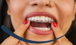 Tips for Invisalign wearers.